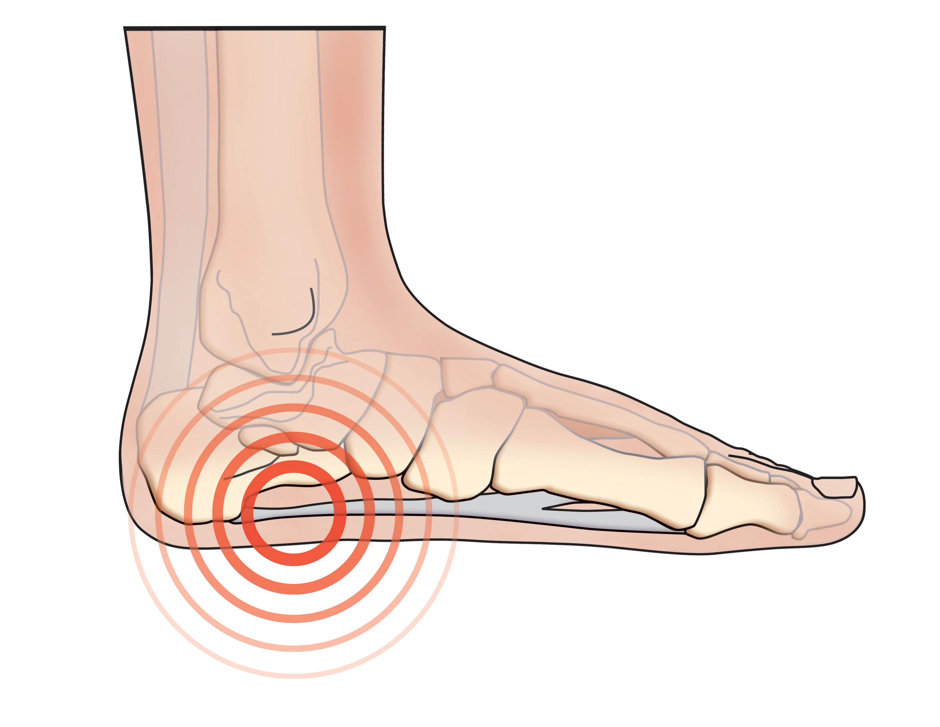 Plantar Fasciitis - E3 Rehab