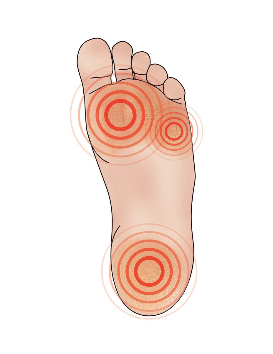 Callus Symptoms