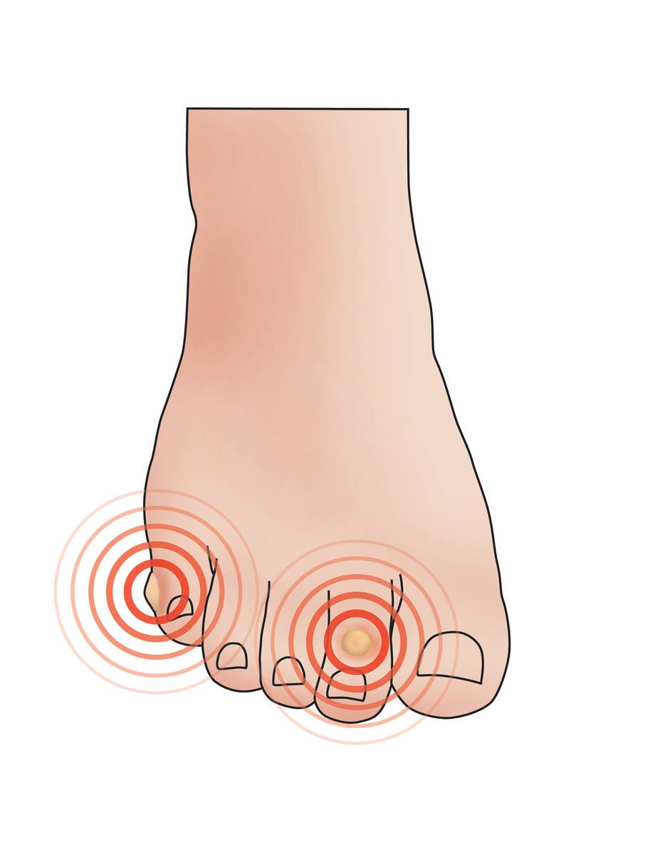 Corns On Feet - Foot Corn Treatment