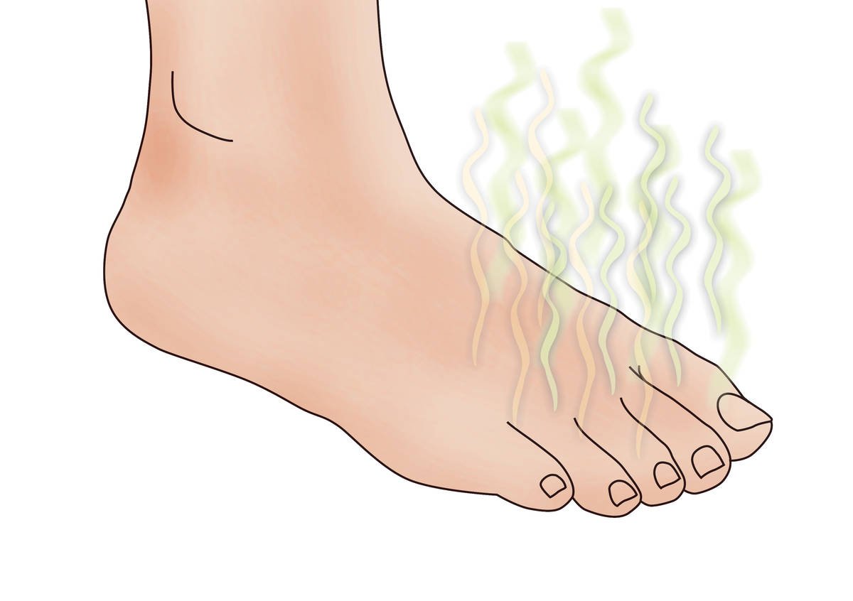 Understand Athlete S Foot Treatment Symptoms Causes And Prevention