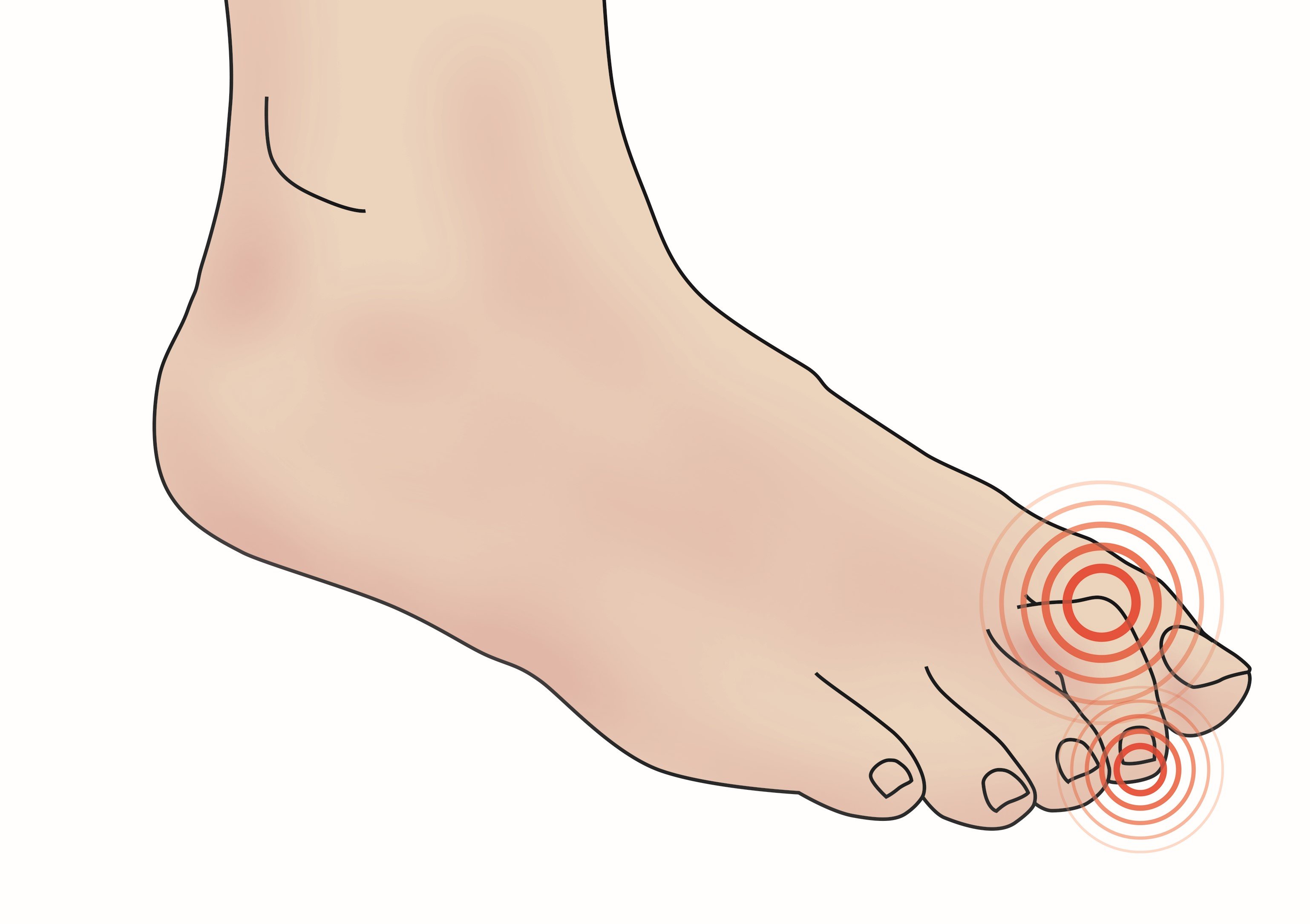 Understand Crooked Toes, Types and Treatment