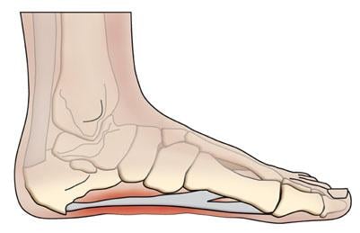 Pain on bottom of foot