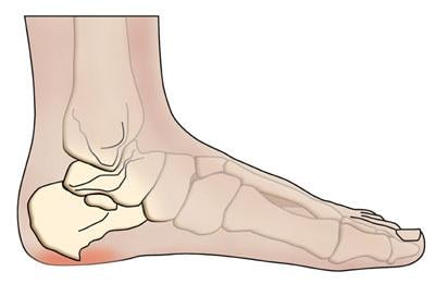 Heel Spur