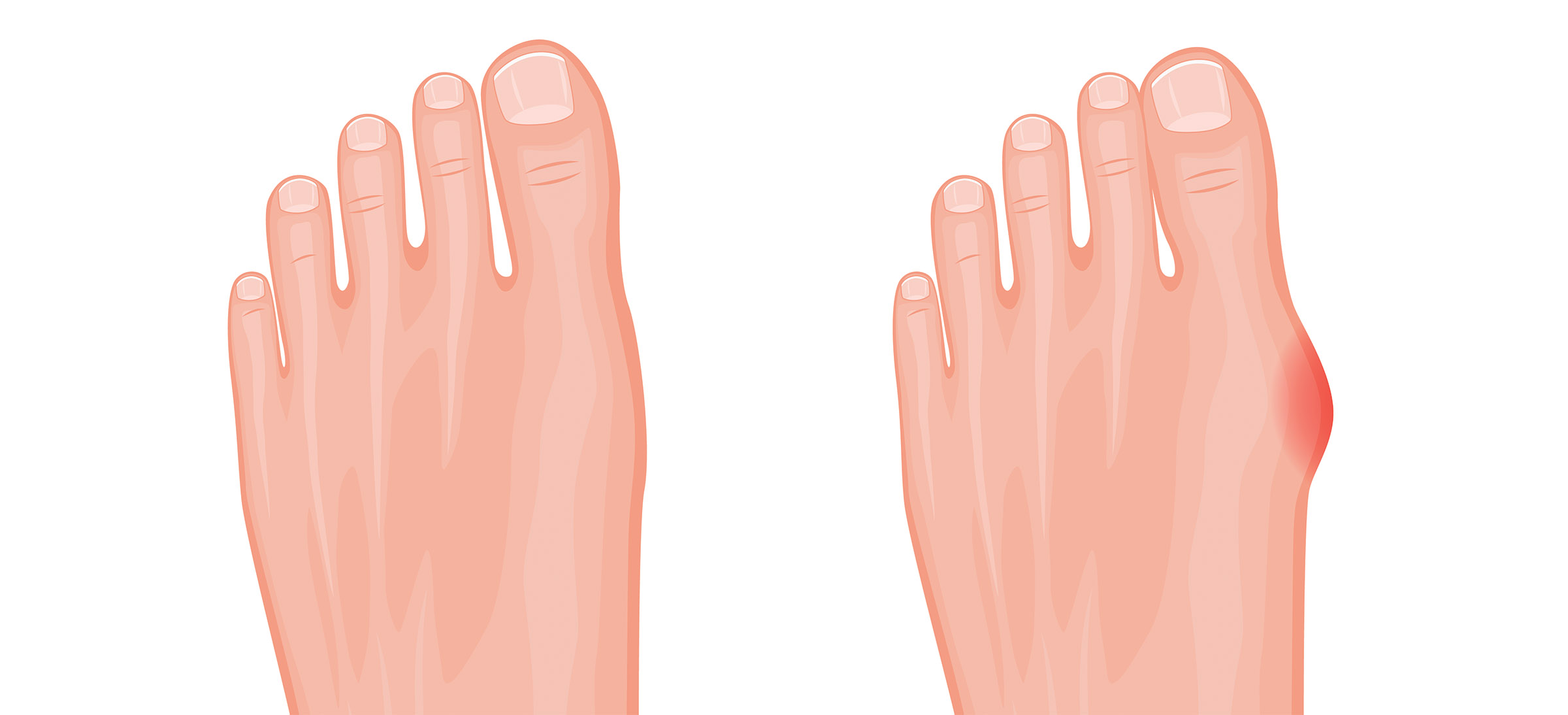 Bunion before and after